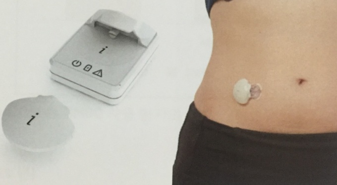 연속혈당측정기(CGM) iPro2, 메드트로닉 제공