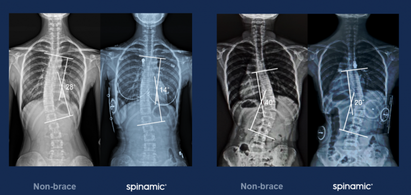 스파이나믹 착용 전후 환자 X-ray 비교