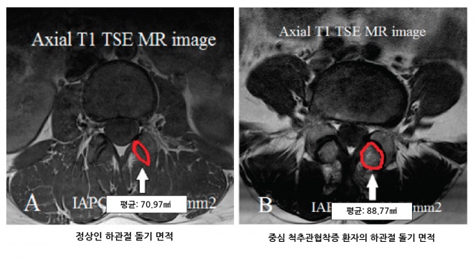 정상인(좌)와 축추관협착증 환자(우)의 MRI비교