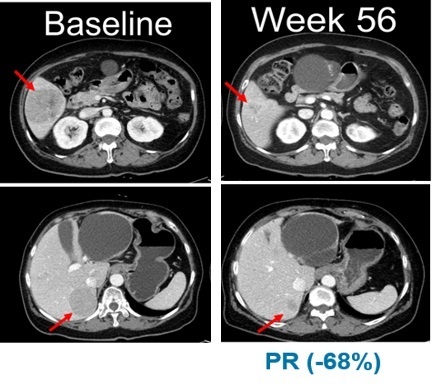 임상 시작 전(Baseline,좌측)과 벨바라페닙 투여 56주 후 흑색종 환자의 복부 CT사진