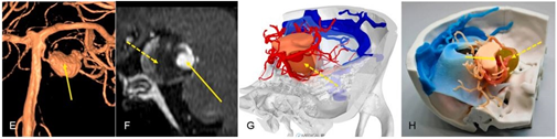 논문에 쓰인 뇌혈관질환 환자 의료영상 기반 3D모델링 및 3D프린팅 case 1. 뇌동맥
