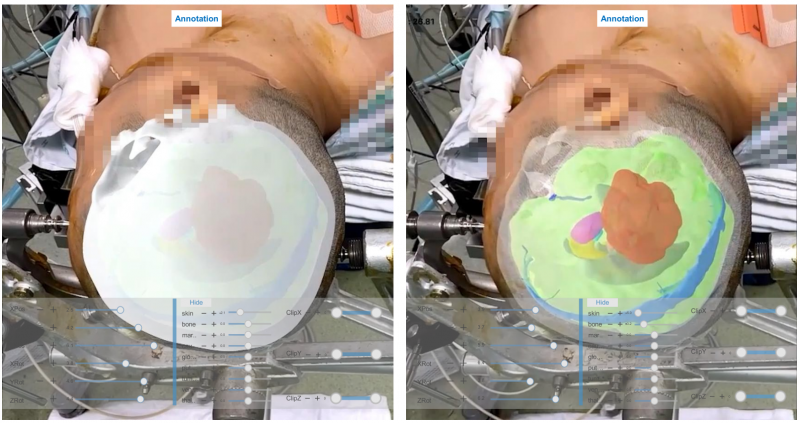 실제 MEDIP PRO AR을 활용해 증강현실로 구현된 환자의 수술 부위.